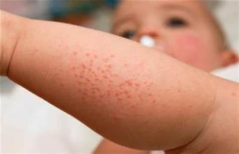 嬰幼兒手肘濕疹照片