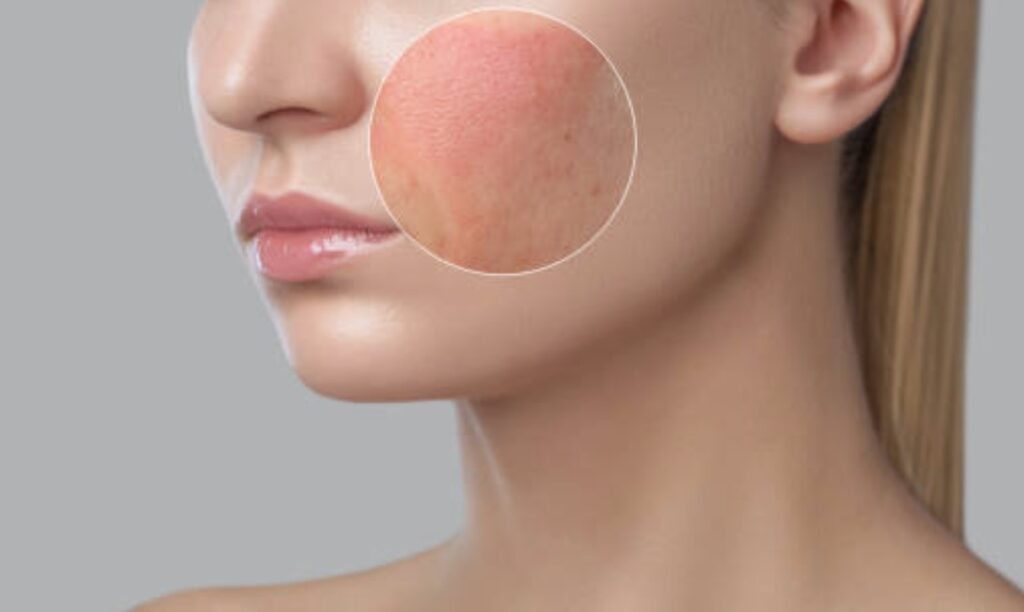 肌膚屏障受損時，臉頰泛紅也更容易發生
