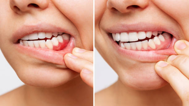 牙齦紅腫是牙齦發炎的症狀之一