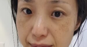 肝斑
